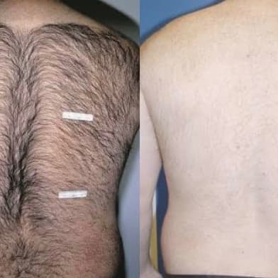“Lite” Full Body Option (6) at Auroura Skin & Smile in Worcester, MA
