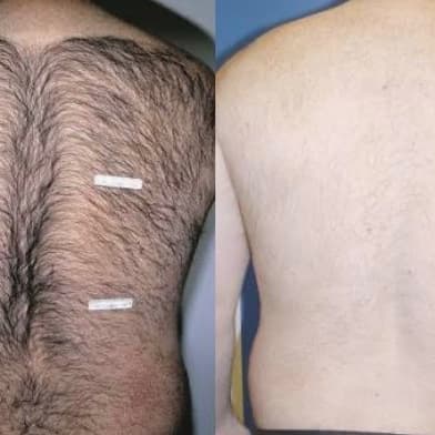 Smooth Full Body Laser Package at Auroura Skin & Smile in Worcester, MA